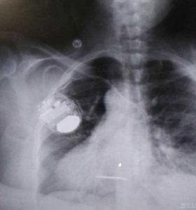 x光片显示米勒胸部的除颤器